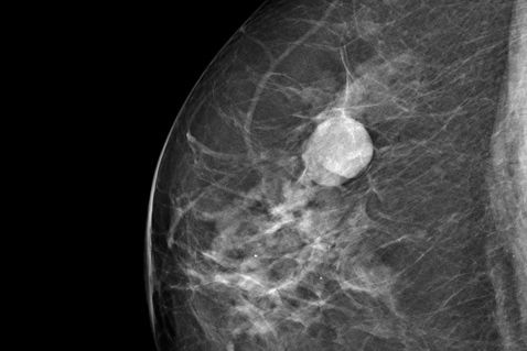 Zyste in Mammogaphie