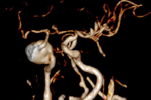 Riesenaneurysma im Schädel hinter dem rechten Auge; Rekonstruktionsmodus Volume Rendering