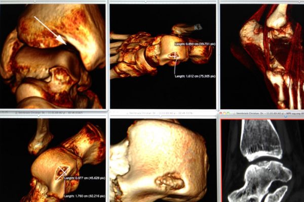 3D-Rekonstruktion (Volume Rendering eines Knochenbefundes am MSCT)