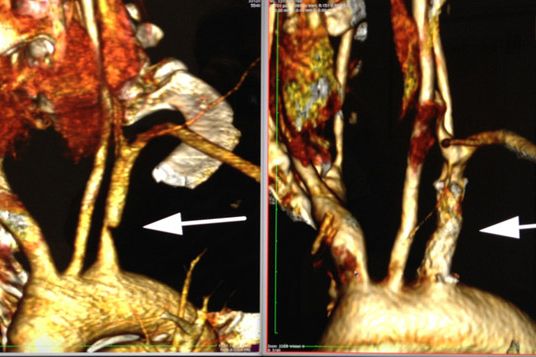 Angio CT vor und nach Stent