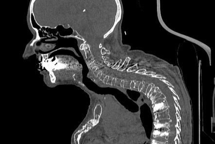 Osteoporotische Wirbelkörperfrakturen, Rekonstruktionsmodus 2D