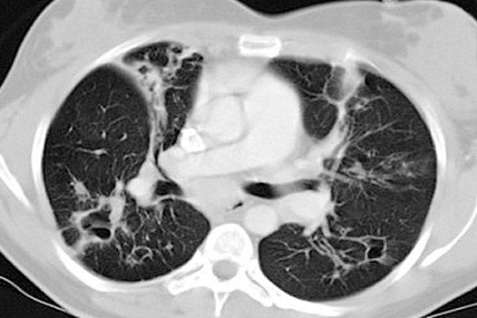 Mukoviszidose im MSCT