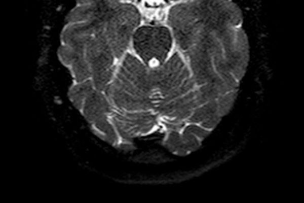 Erhöhter Liquordruck im Schädel mit Stauungspapille
