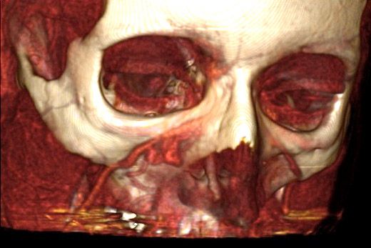 3D-(GefäßmißMSCT)