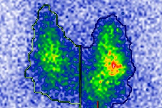 Schilddrüse mit autonomen Adenom