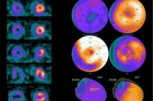 Herz - unauffälliger Muskelstoffwechsel