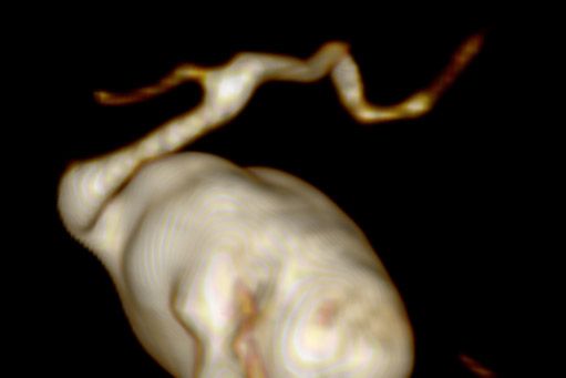 Riesenaneurysma im Schädel hinter dem rechten Auge