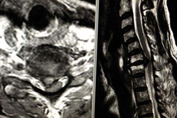Bandscheibenvorfall im MRT