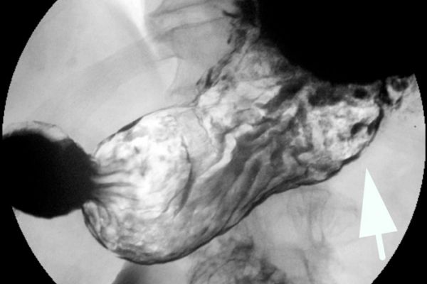 Magenulkus in Doppelkontrasttechnik in der Durchleuchtung